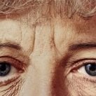 SUBCISION – Tratamento Rugas